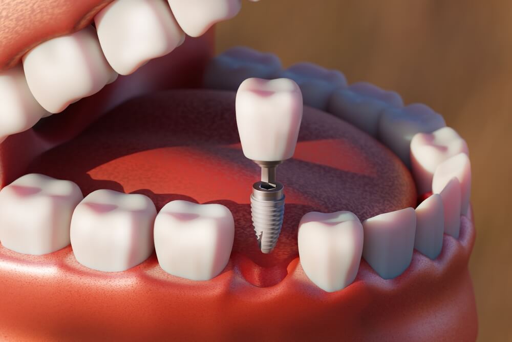 Bir günde implant