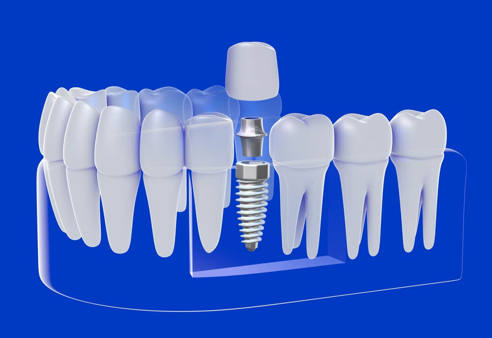 Diş implantları
