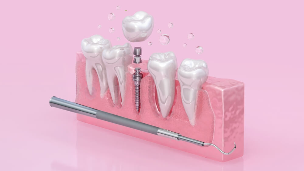 Fast fixed implant