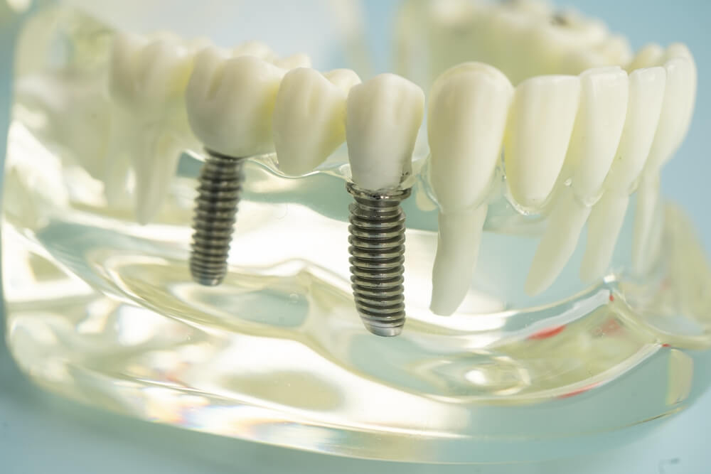 ileri implant tedavisi