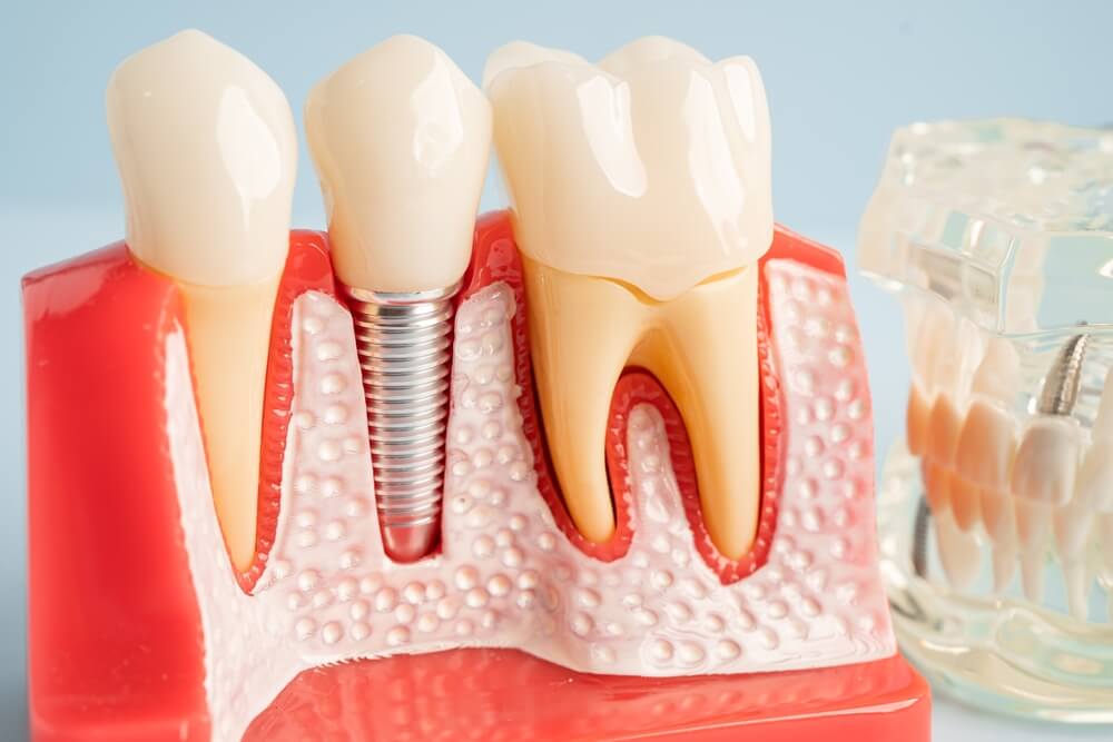 implant tedavisi