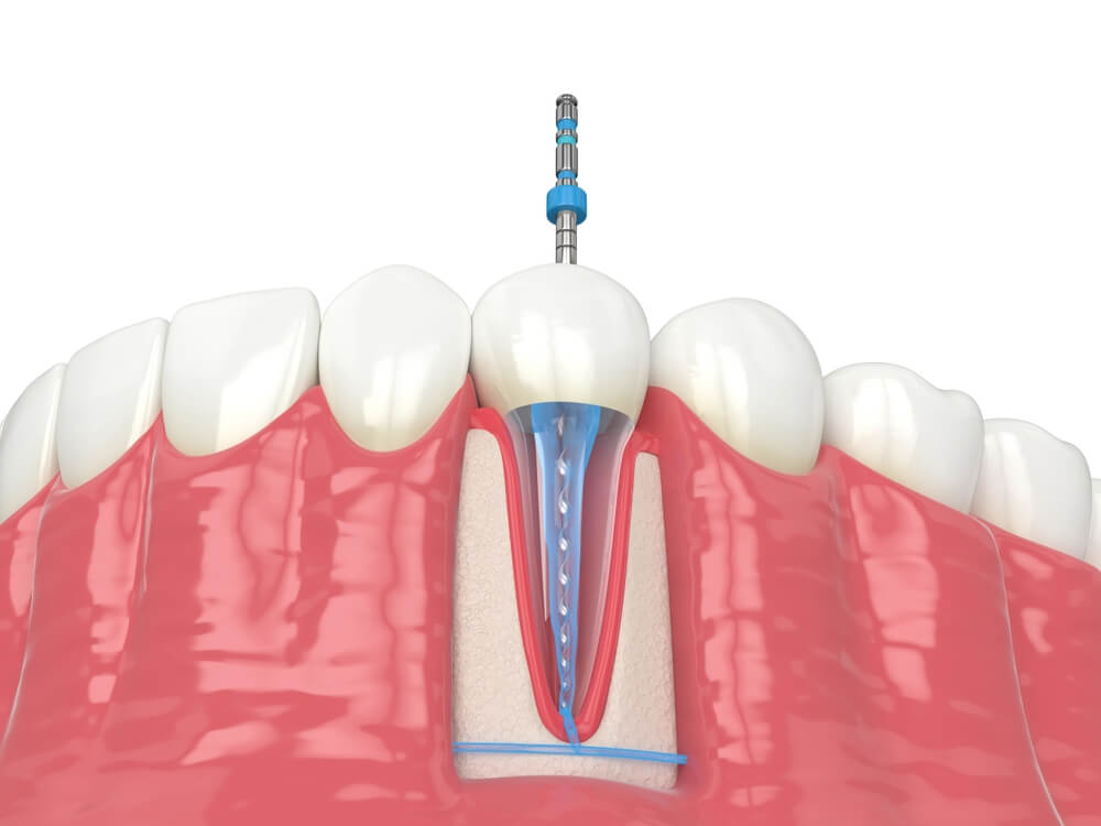 Rejeneratif Endodonti Tedavisi